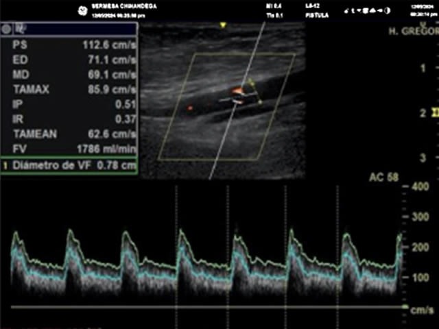 High-Flow Arteriovenus fistula Syndrome (BCF)