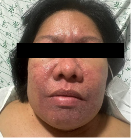 Before removal of central venous catheter