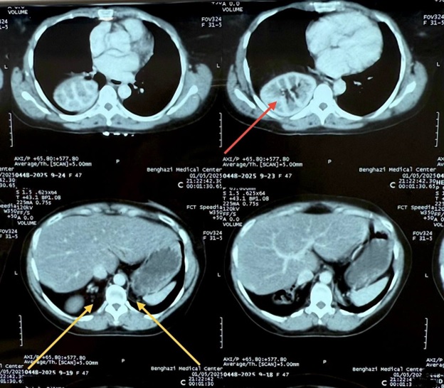 Computed tomography (CT) scan of the lower thorax and abdomen showing the presence of the right kidney in the right hemithorax (red arrow), and the absence of both kidneys in the retroperitoneum (yellow arrows).