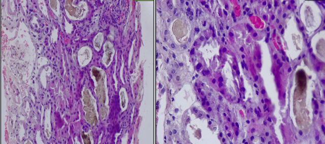 Fig A. Bile casts in tubules