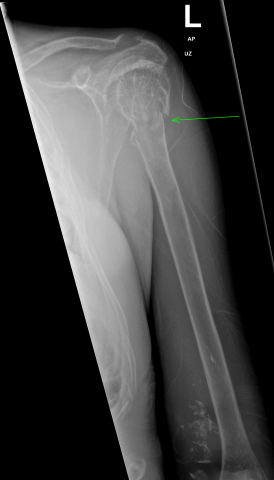 Pathological humerus fracture