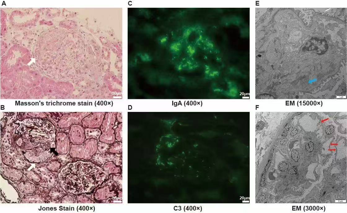 Figure1 Endocapillary hypercellularity (black arrows) and cellular crescent (white arrows) under light microscopy (A, B). Immunofluorescence demonstrated IgA (+~++) and C3 (+~++) mesangial deposition (C, D). Electron-dense materials (blue arrows) and foot process fusion (red arrows) under electron microscope (E, F). EM, electron microscope.
