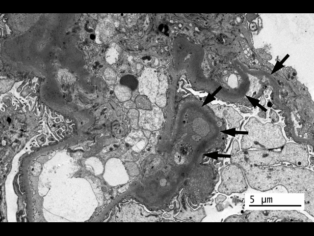 EM image from the transplant biopsy, arrows showing the areas of dense deposit material in the glomerular basement membranes, that is typical of dense deposit disease.