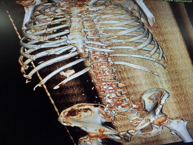 the kidneys 2