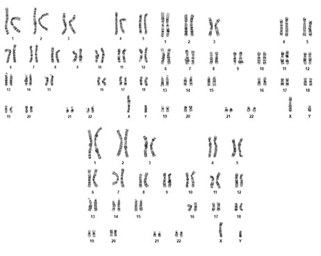 Figure 1. ISCN Result: 46, XY chromosome, Male Karyotype