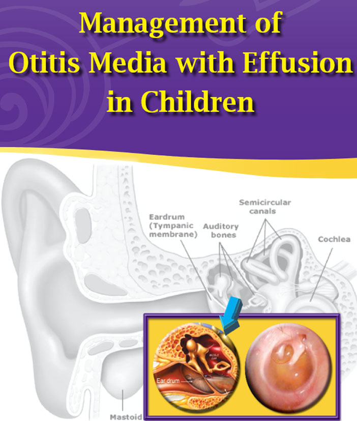 Management-of-Otitis-Media-with-Effusion-in-Children