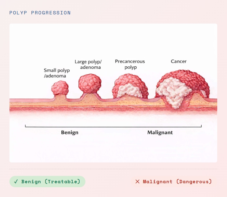 What is Colorectal Cancer image