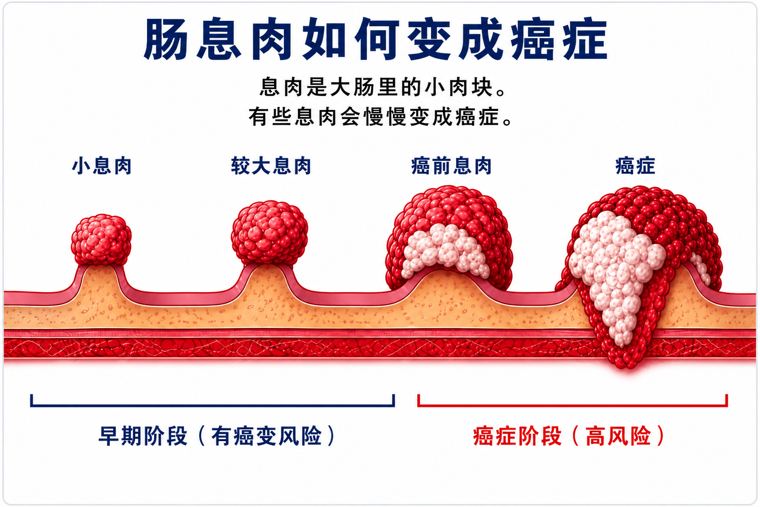 What is colon cancer - Chinese image