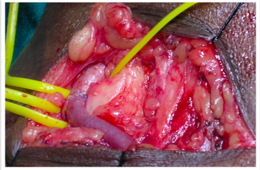 Arteriovenous Fistula (AVF)