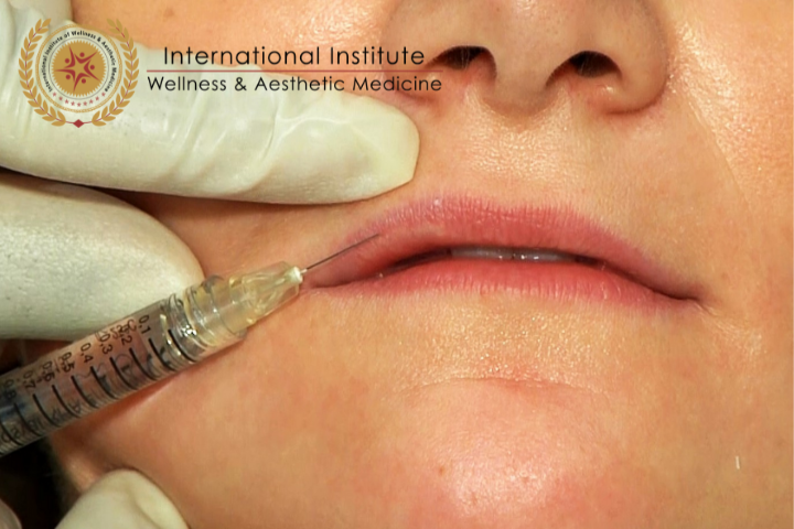 LIP FILLER TIPS FOR NEW AESTHETIC PRACTITIONERS