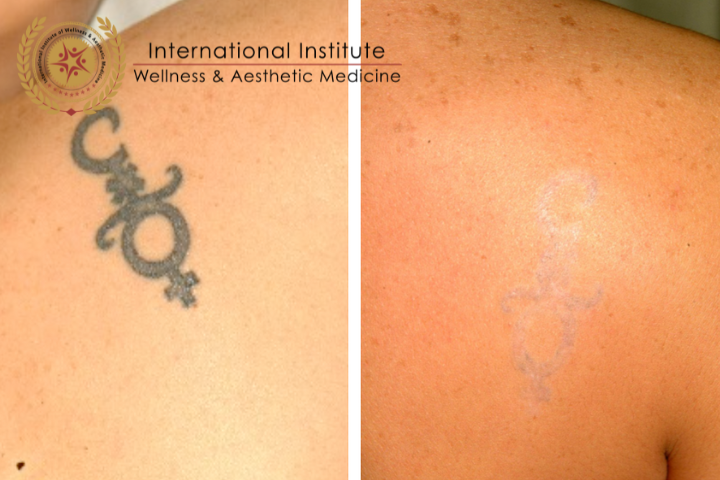 SAFETY MEASURES AND COMPLICATIONS OF LASER TATTOO REMOVAL