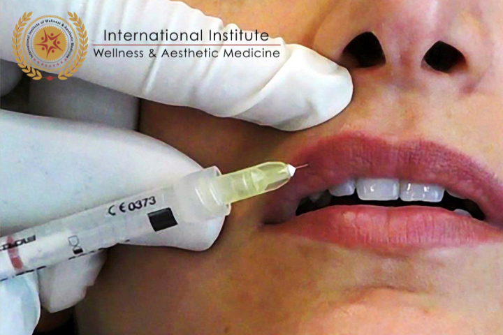 ABOUT FAT INJECTION FOR LIP ENHANCEMENT
