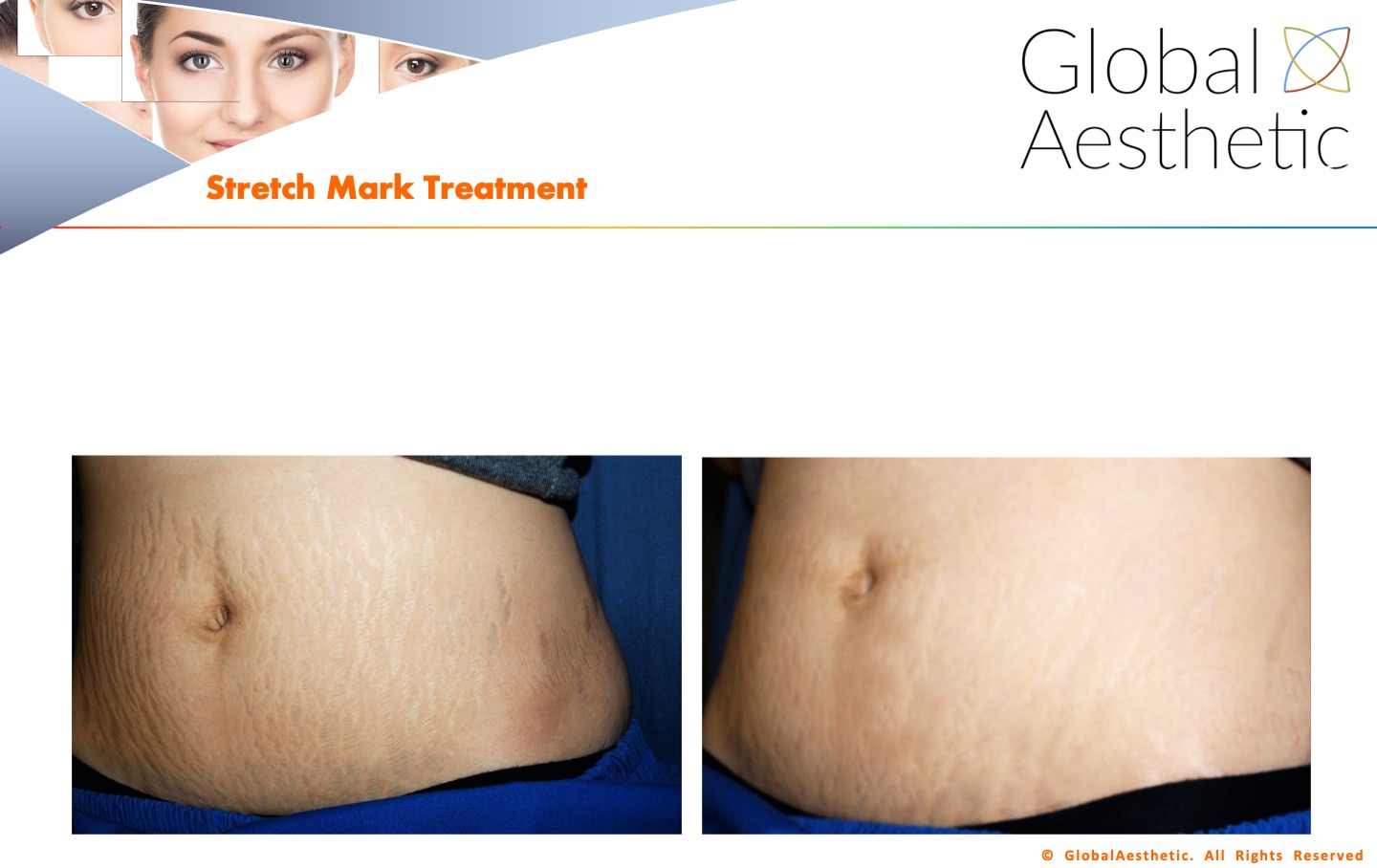 Stretch Marks Treatment - The Center for Women's Aesthetics