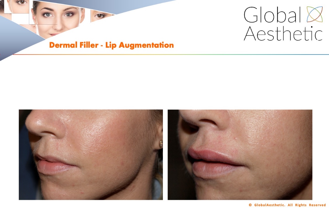 lip fillers injection treatment