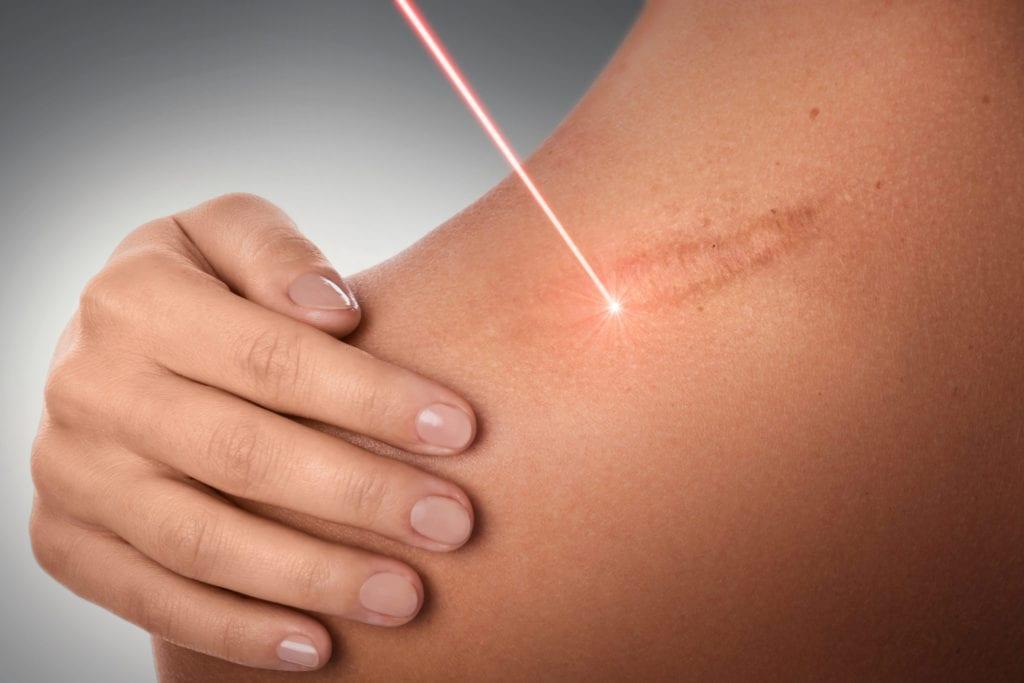 laser treatment for stretch marks