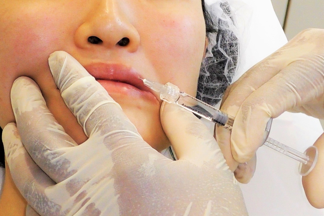 lip fillers injection treatment