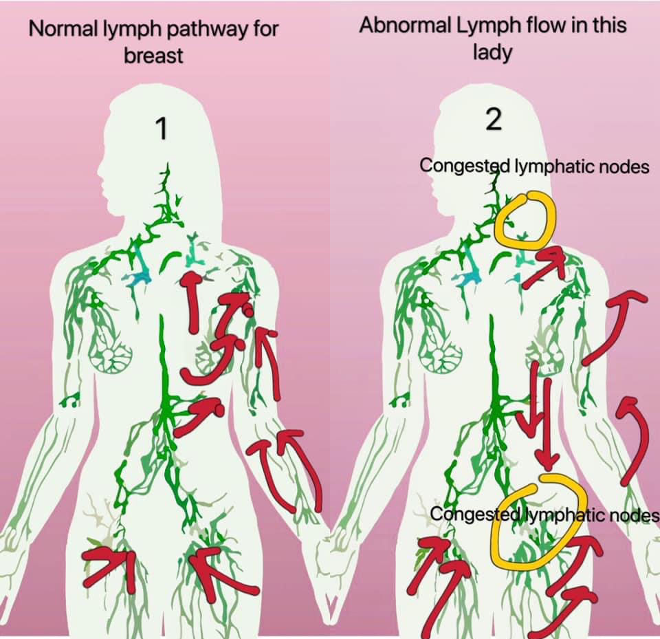 Will you suffer from abnormal lymphatic flow in normal circumstances (no cancer and operation)?