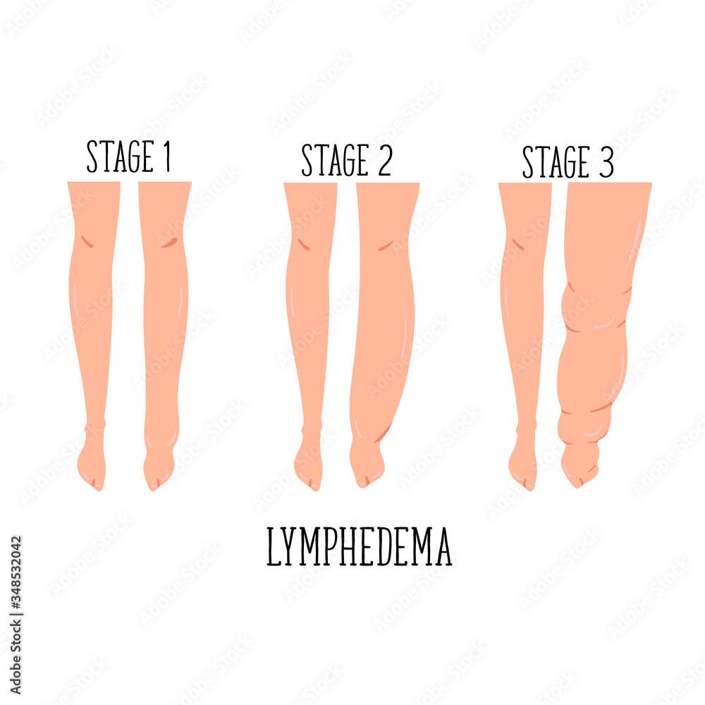 Is my lymphedema serious? What are the stages of lymphedema?