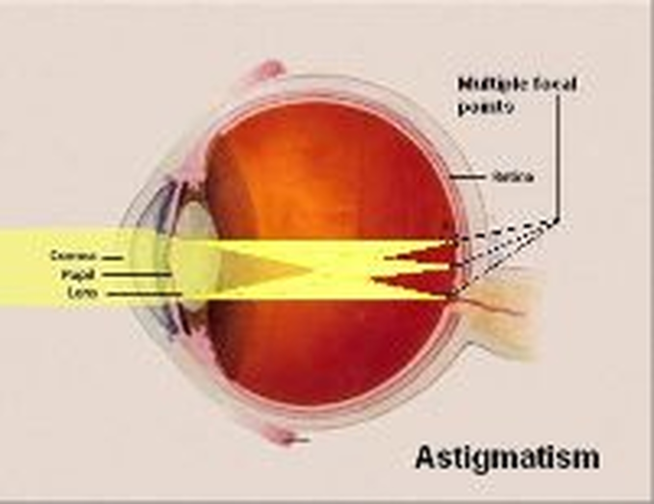 eye-exam-for-astigmatism-eye-exam-hyperopia-and-myopia