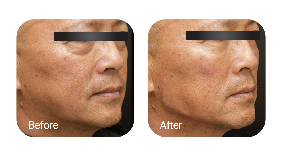 Middle & Lower Face Make Up <span>Tear Trough, Cheek Lift & Jawline</span>